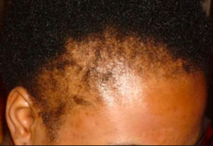 Luxju - Hair Loss At The Hairline - Edges